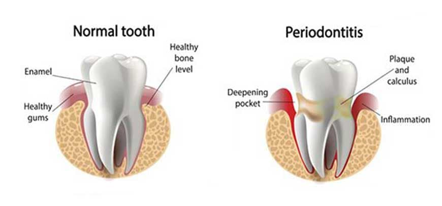 Gum Disease Therapy