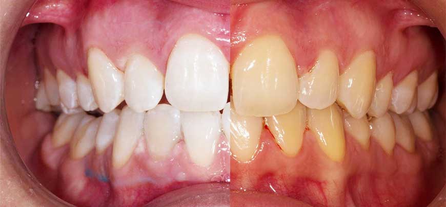 Teeth Whitening