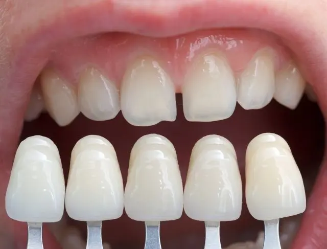 composite dental veneers paphos dentist