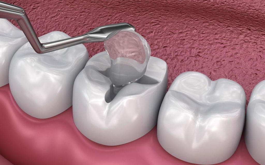 dental fillings paphos dentist
