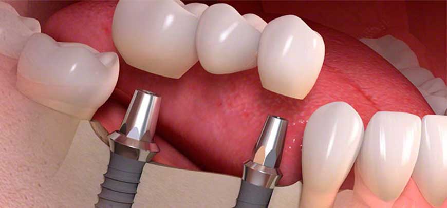 dental implants paphos