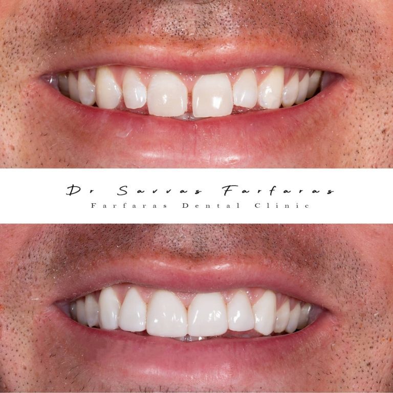 paphos dentist before after teeth farfarasdental 1