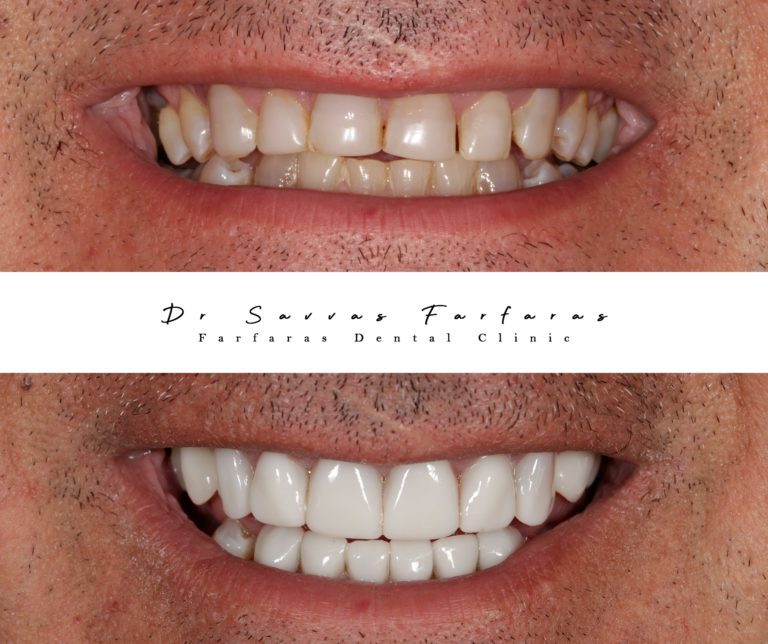 paphos dentist before after teeth farfarasdental 11