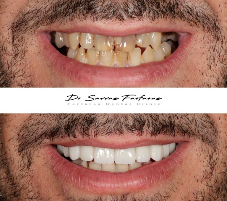 paphos dentist before after teeth farfarasdental 13