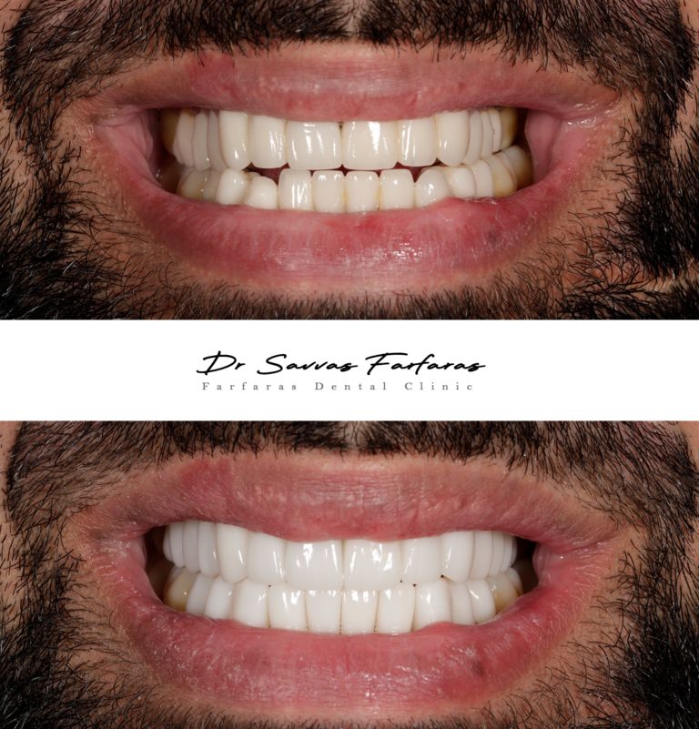 paphos dentist before after teeth farfarasdental 14