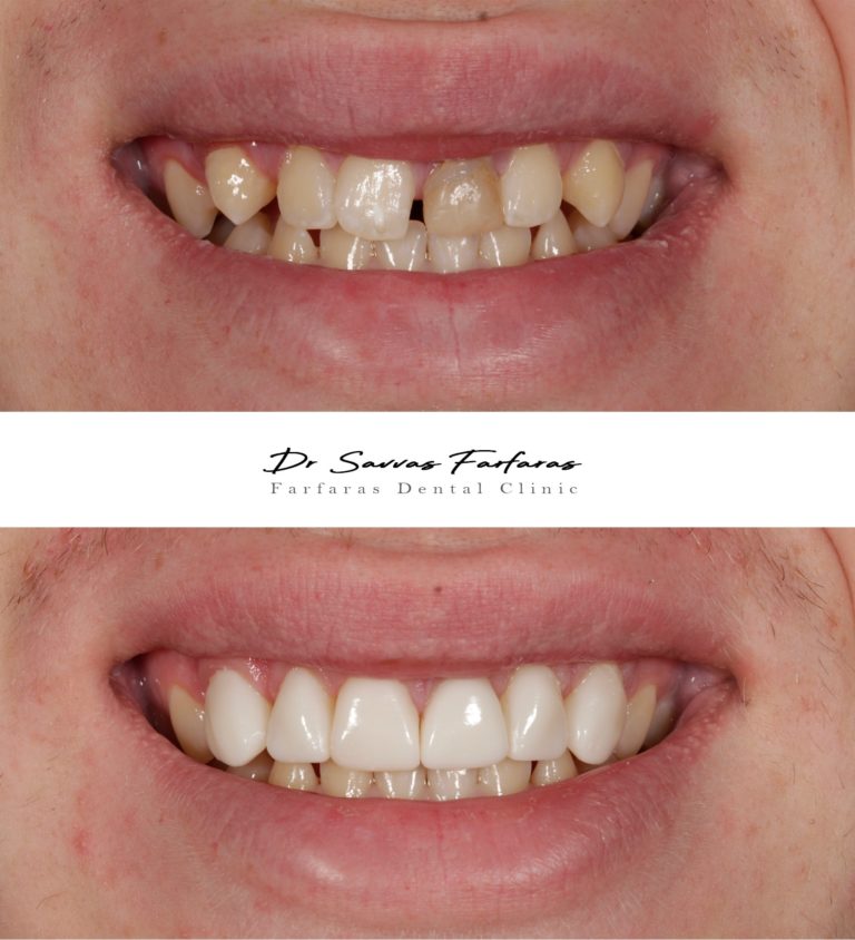 paphos dentist before after teeth farfarasdental 15