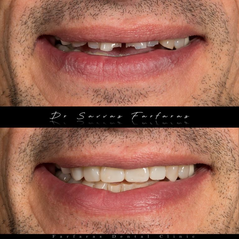 paphos dentist before after teeth farfarasdental 2