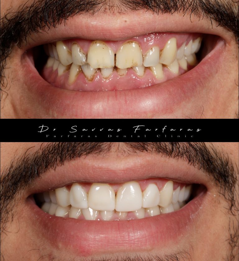 paphos dentist before after teeth farfarasdental 4
