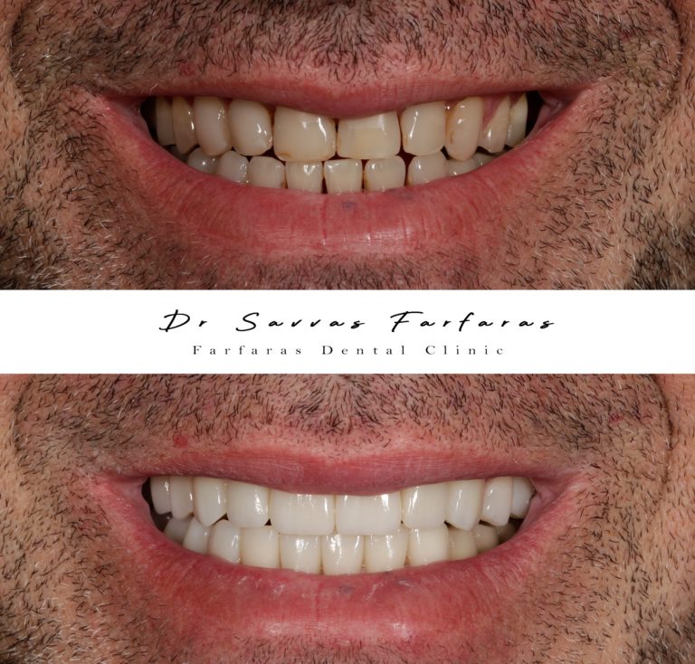 paphos dentist before after teeth farfarasdental 6