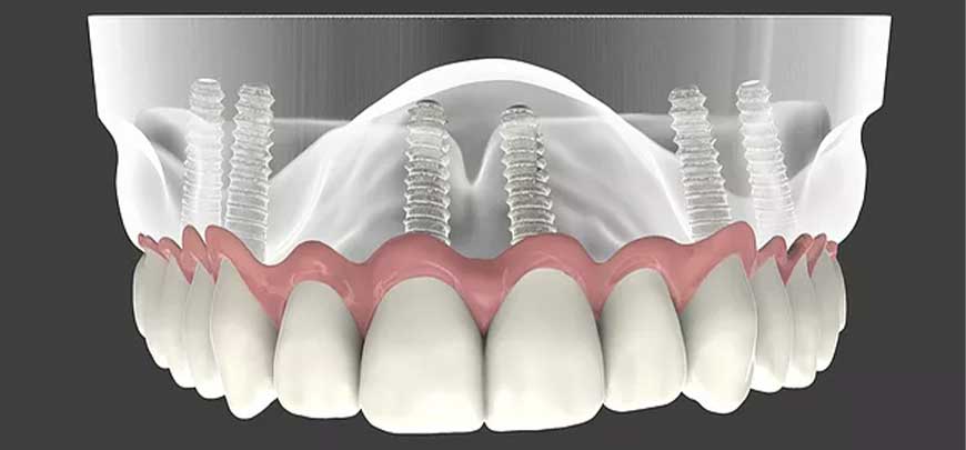 prosthetic dentistry paphos